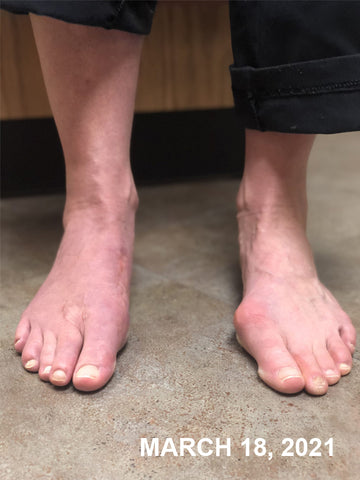 StrongJoints Bunion əleyhinə yamaqlar