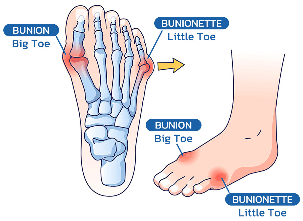 Projoint AntiBunions Health Sock