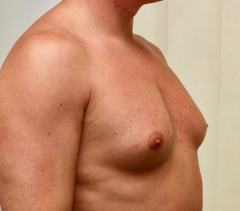 เครื่องนวดลดขนาด GFOUK™ EMS Gynecomastia