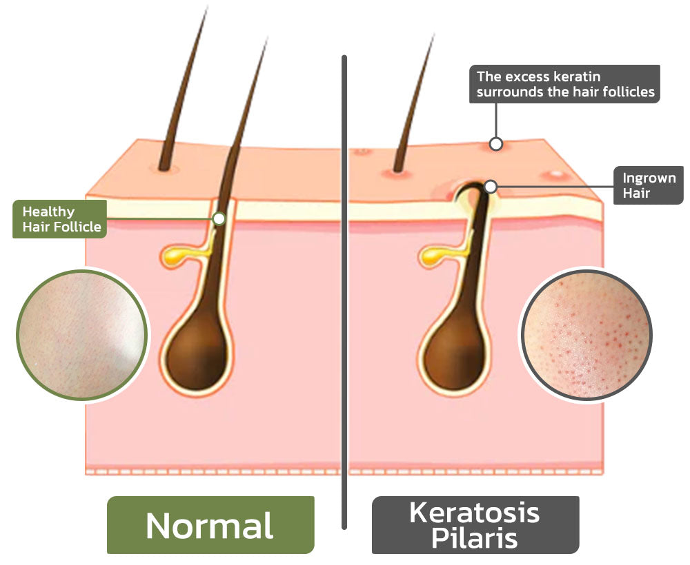 flysmus™ KeratosisTreat Deep Clean Smooth Creme