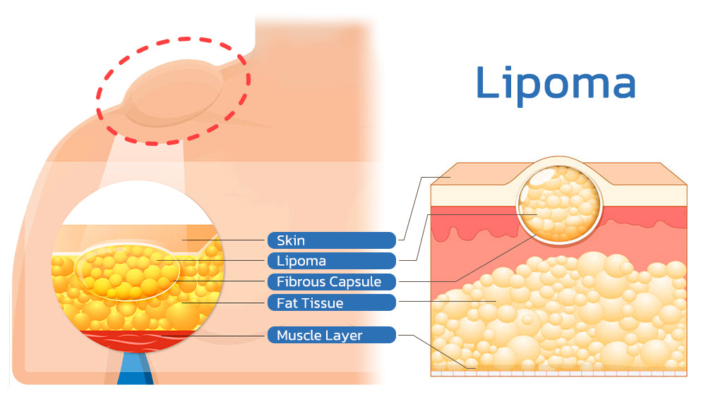 Herblymph Lipomheilung Removing Cream