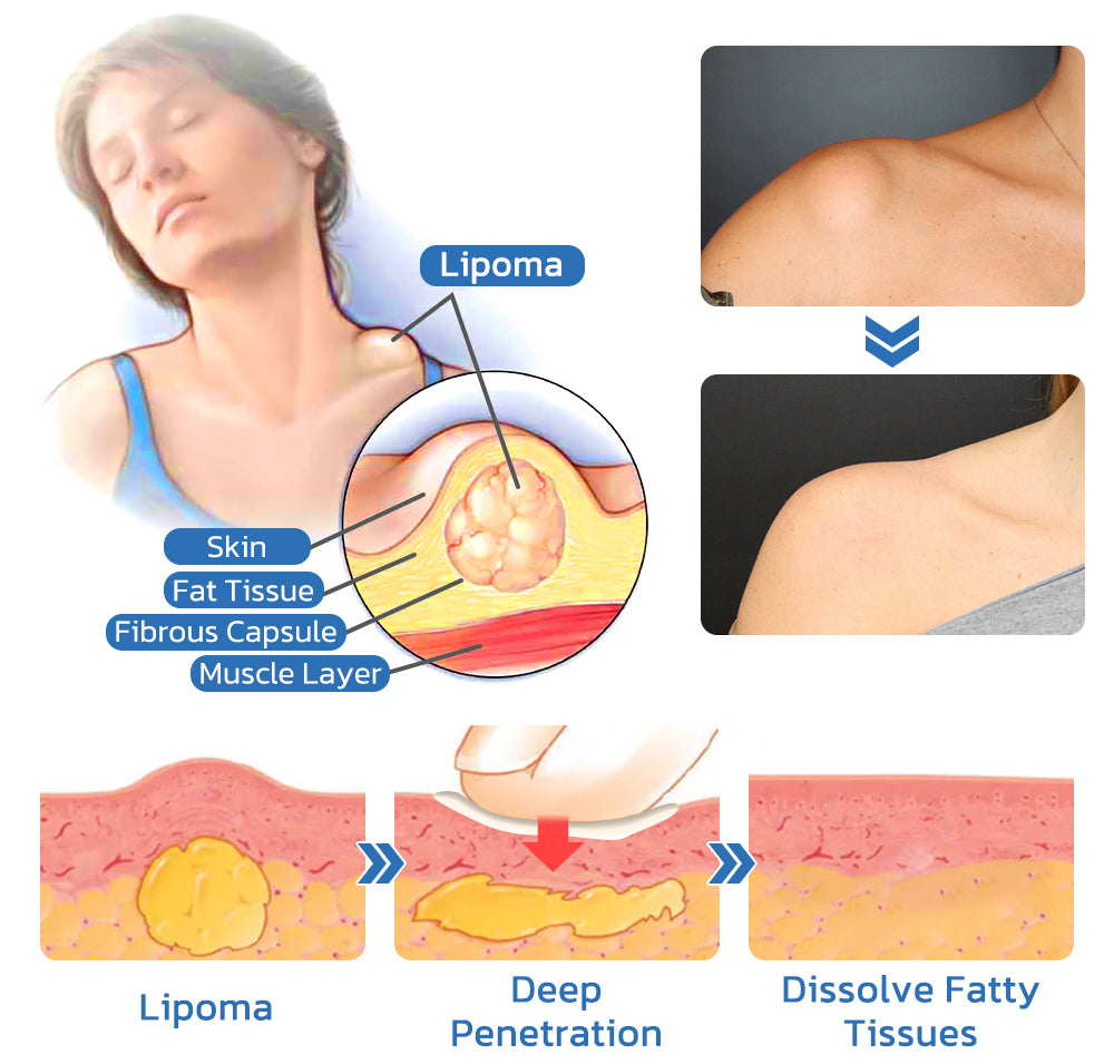 Herblymph Lipomheilung Removing Cream