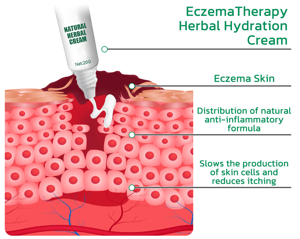 EczmoTherapy Herbal Healing Cream