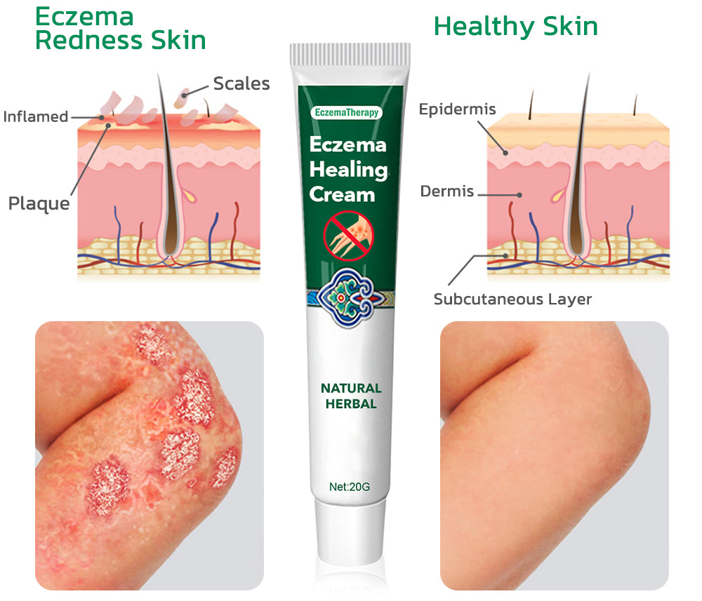 EczmoTherapy Herbal Healing Cream