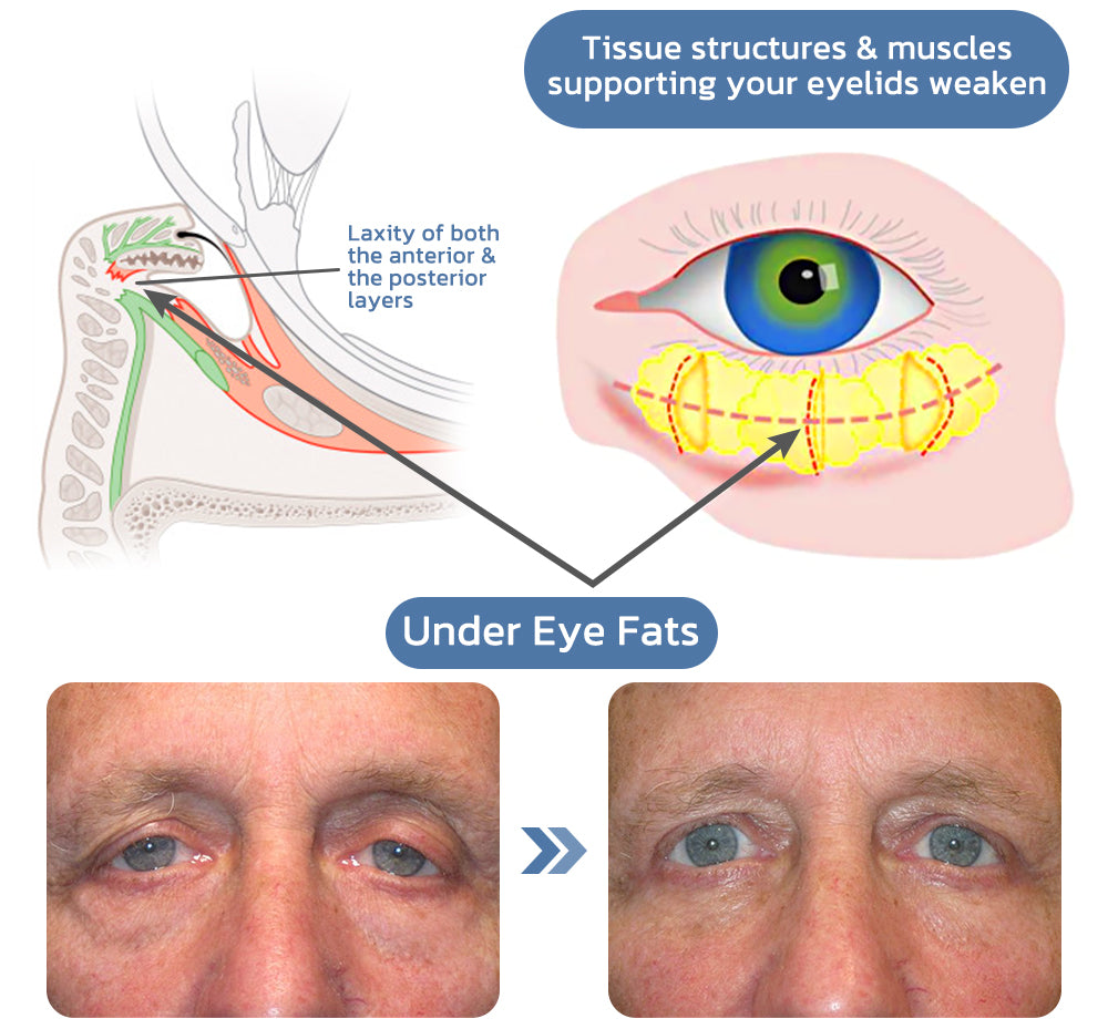 flysmus™ OPENEYES Erwecken Peptid Straffende Augengel