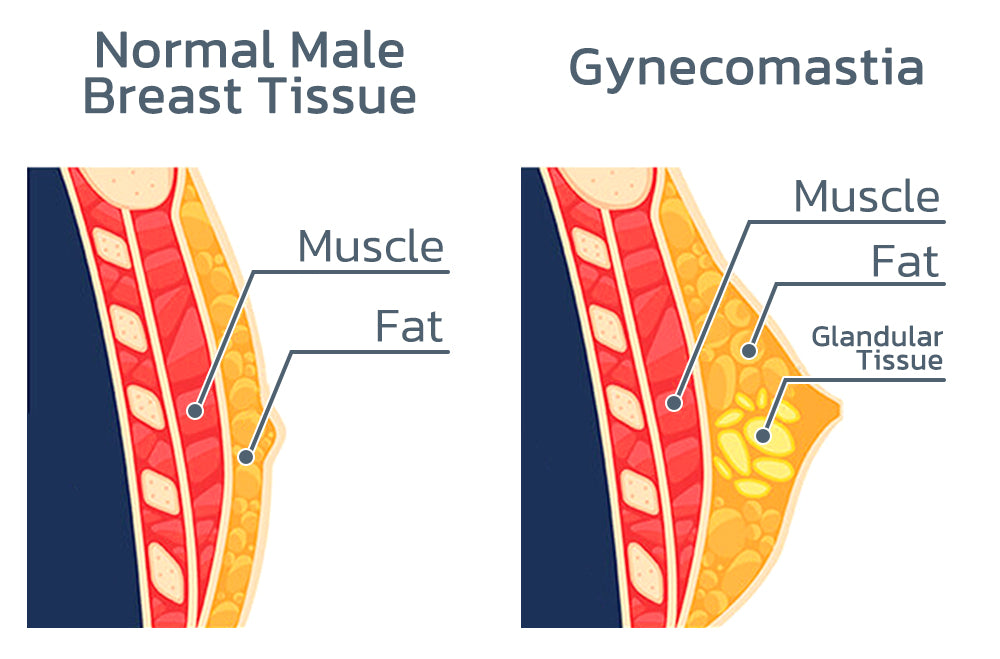 Chestlift Gynecomastie Massage Oil