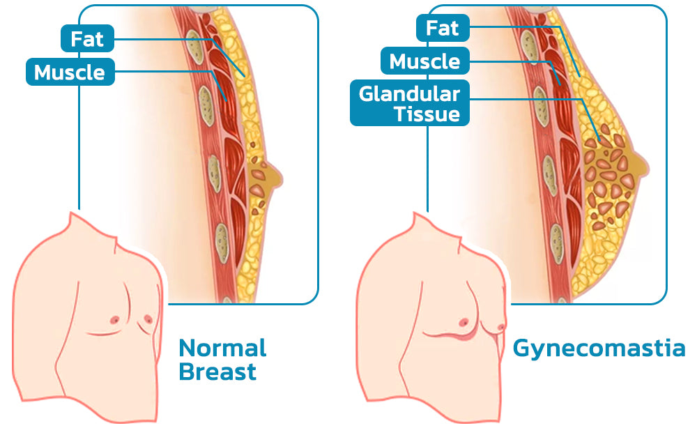 LUCKYSONG™ GKTY Gynecomastia Compress Tank Top