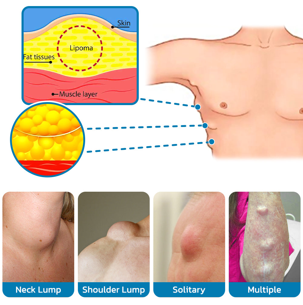 LipoOut Lipomheilung Lessening Spray