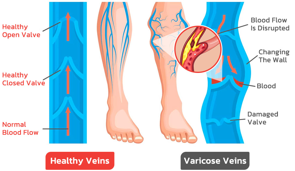 CNDB VeinLess Immediate Relief Herbal Patch