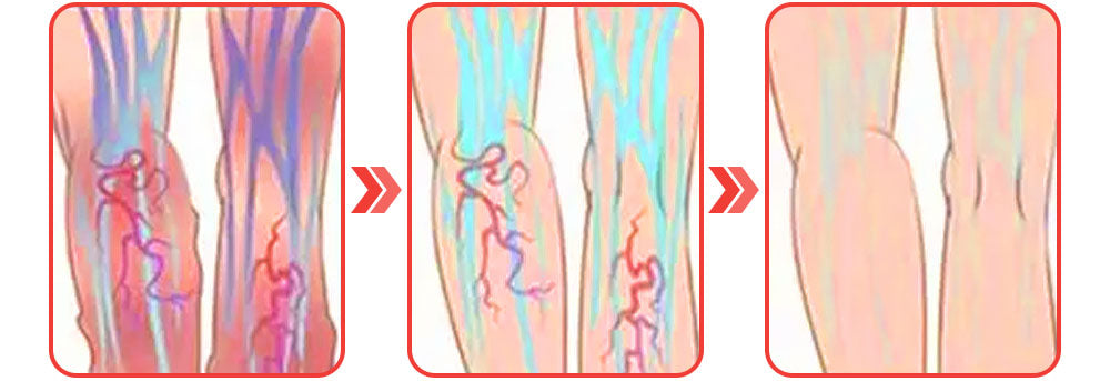 GFOUK™ VeinLess Kräuterpflaster zur sofortigen Linderung