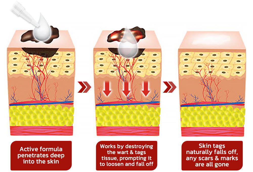 Meellop™ Tags & Moles Remover