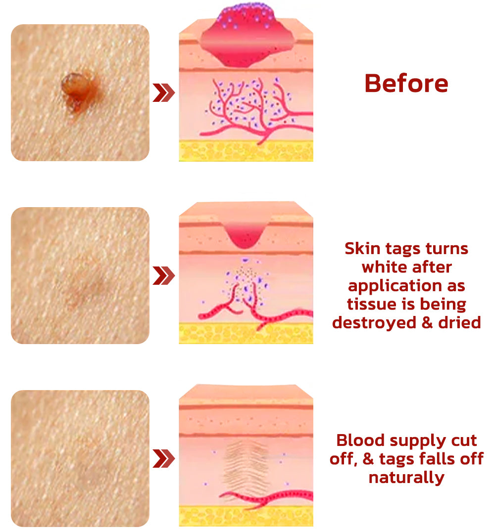 Meellop™ Tags & Moles Remover