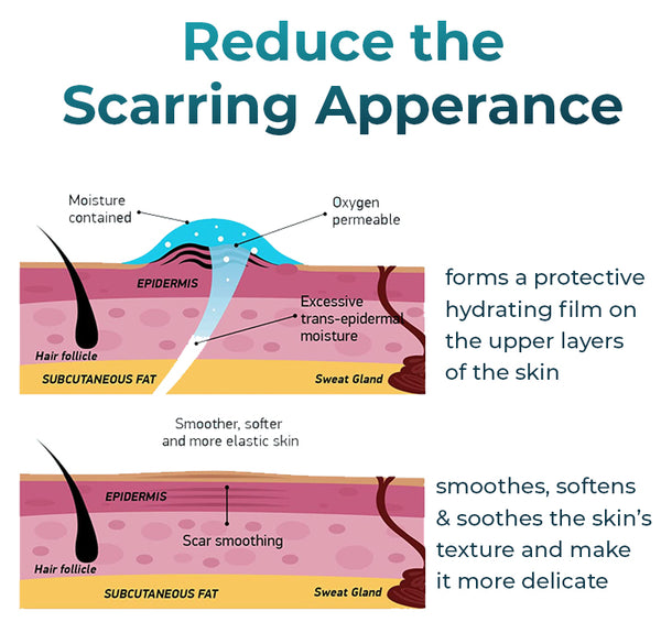 Bioskin™ Fortgeschrittenes Gel zur Narbenentfernung