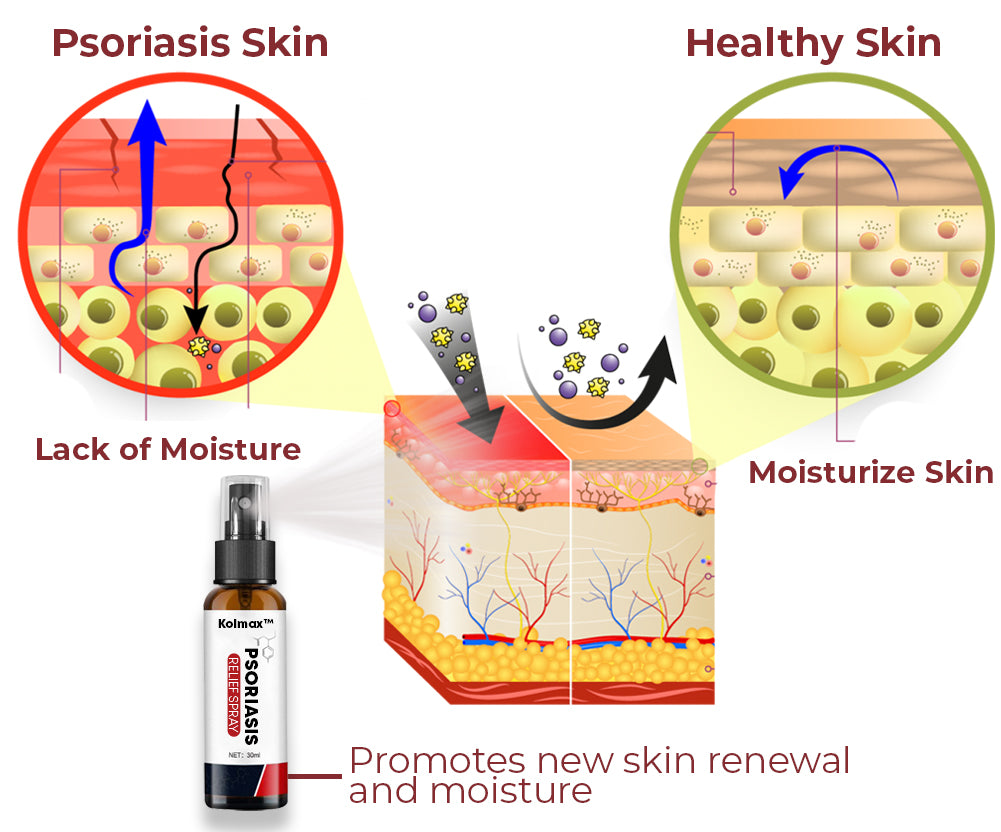 Kolmax™ Psoriasis Relief Spray