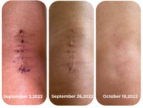 CNDB Bioskin™ Advanced Scar Removal Gel 