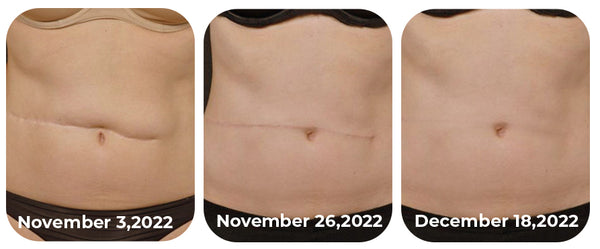 CNDB Bioskin™ Advanced Scar Removal Gel