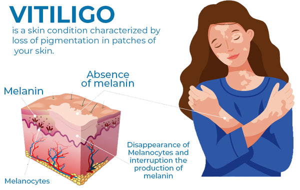 Kolmax™ Vitiligo Soothing Ointment 