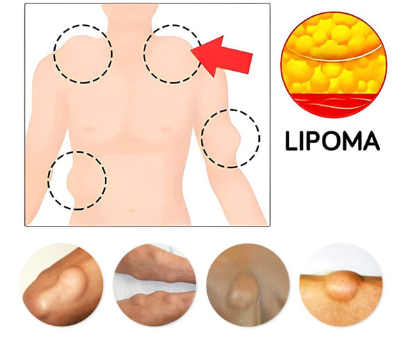 CurSkin™ Lipoma Treatment Ointment