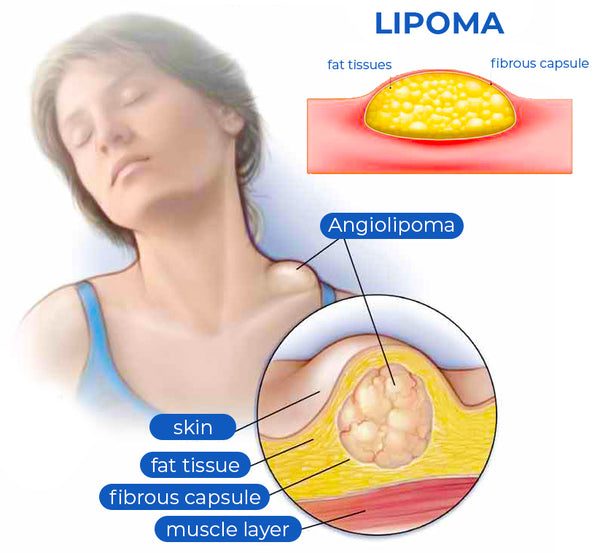 LipomaOut™ Neck EMS Ultrasonic Massager