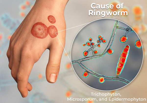 GFOUK™ Hand Ringworm Relief Spray