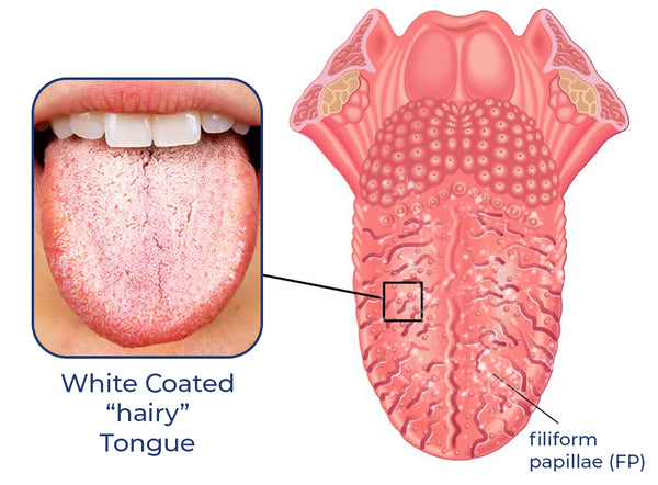 Canada Bioluma™ White Hairy Tongue Removal Kit