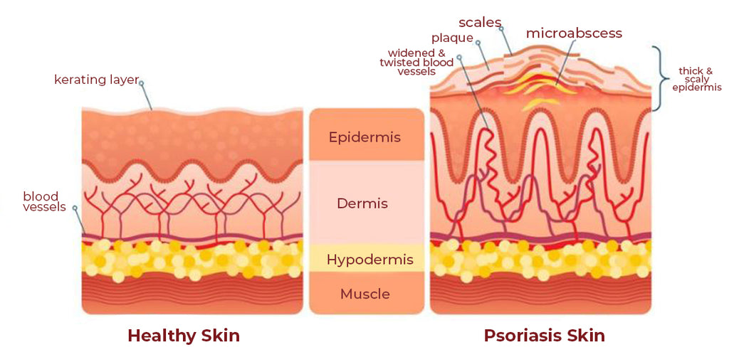 Mory Moisturizing Psoriasis Essence Soap