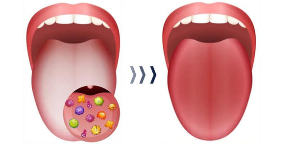 Canada Bioluma™ White Hairy Tongue Removal Kit