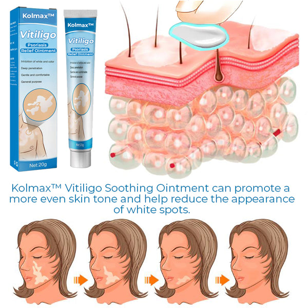 Kolmax™ Vitiligo Soothing Ointment 