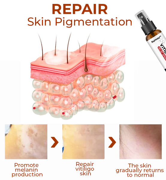 Shinyme Vitiligo Skin Repair Cream