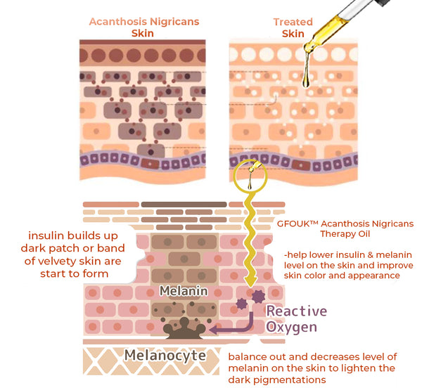 GFOUK™ Acanthosis Nigricans Relief Oil