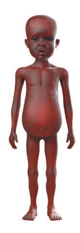 NIño con Kwashiorkor