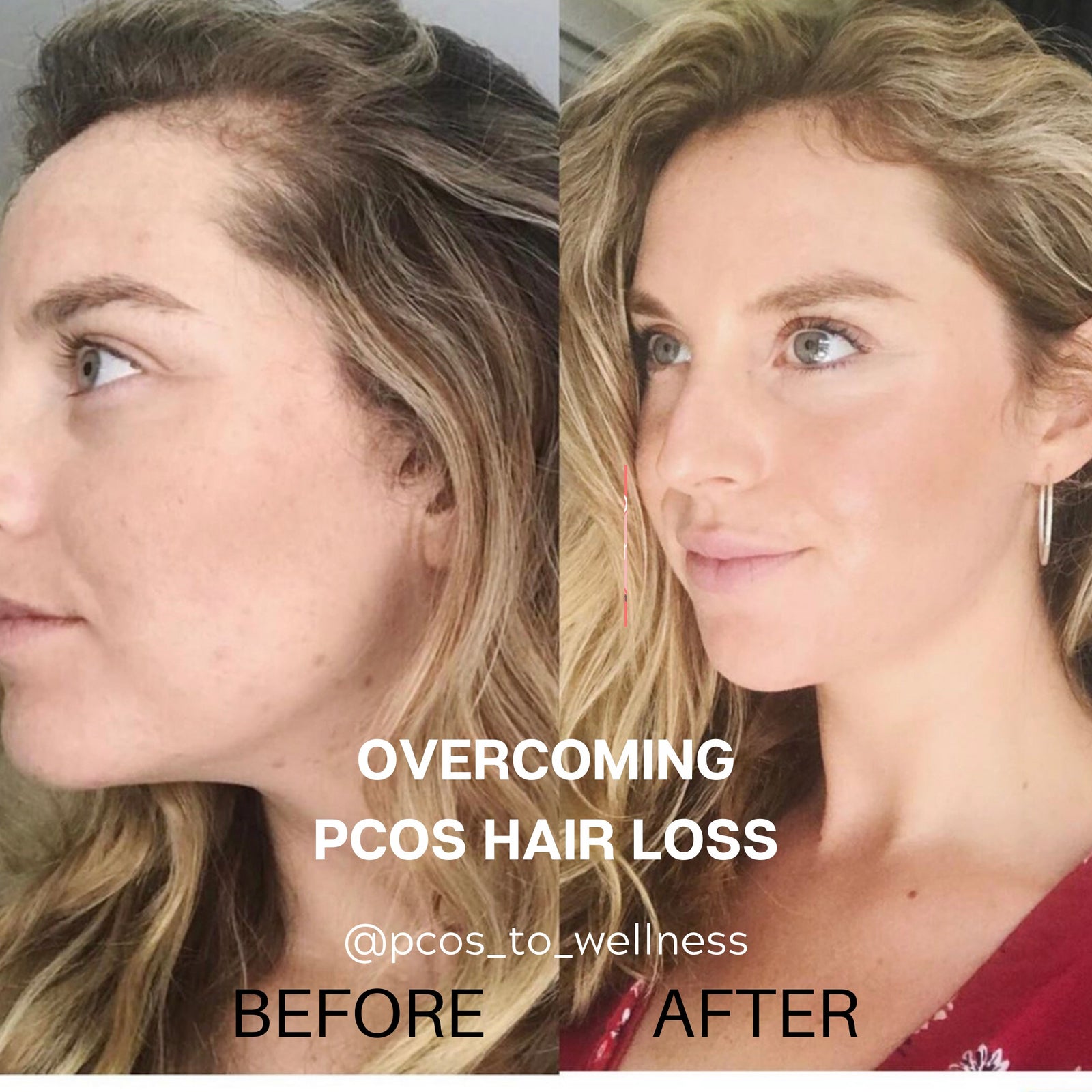 PCOS And Facial Hair  Hirsutism Causes And Hair Removal Tips