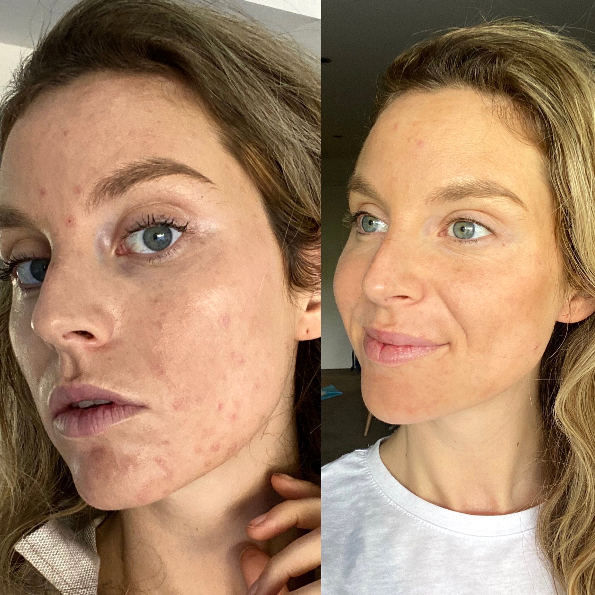 How I Healed My Pcos Acne Naturally Pcos To Wellness