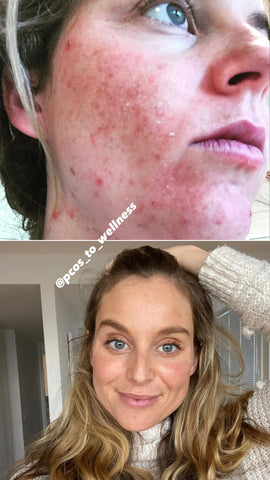 pcos acne treatment