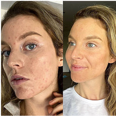 My acne journey with pcos