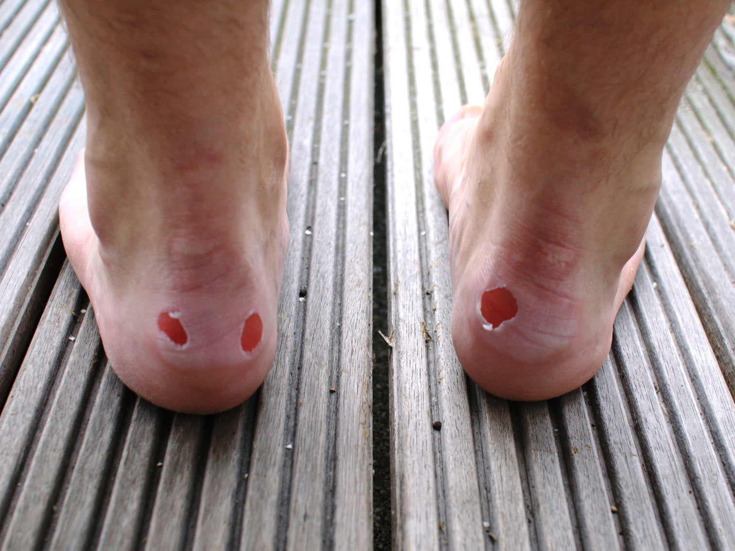 Photo of heel blisters