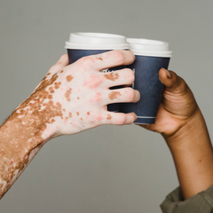 mano con piel vitiligo