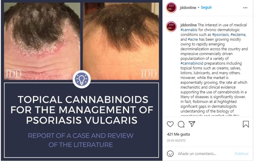 aceite cbd para el pelo y la alopecia