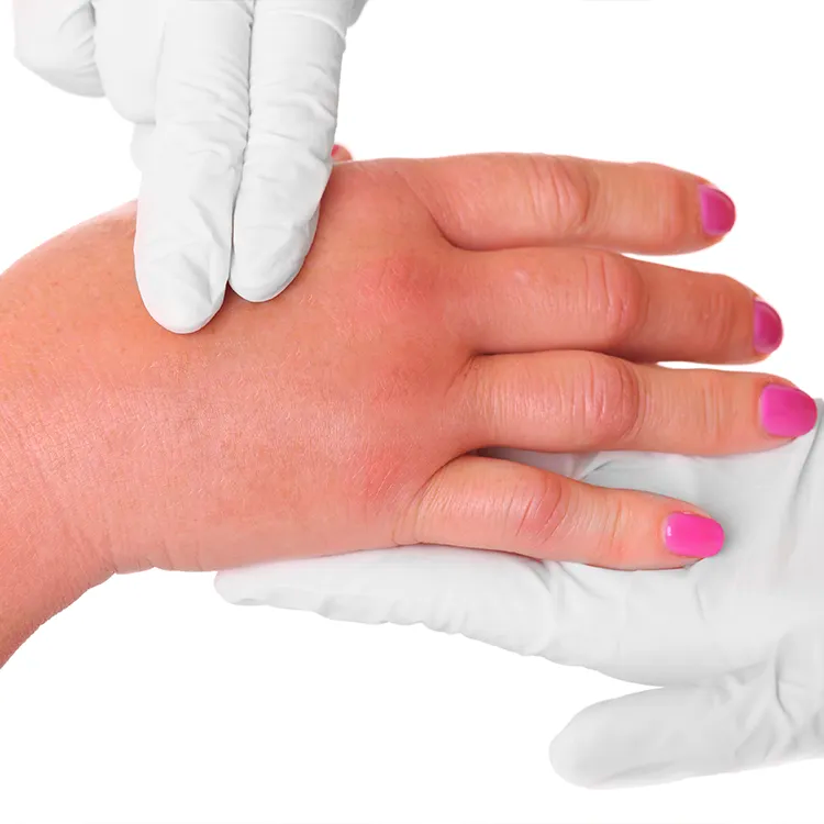 Redness and swelling