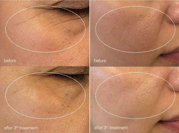 Before and After image of treatment on client's face