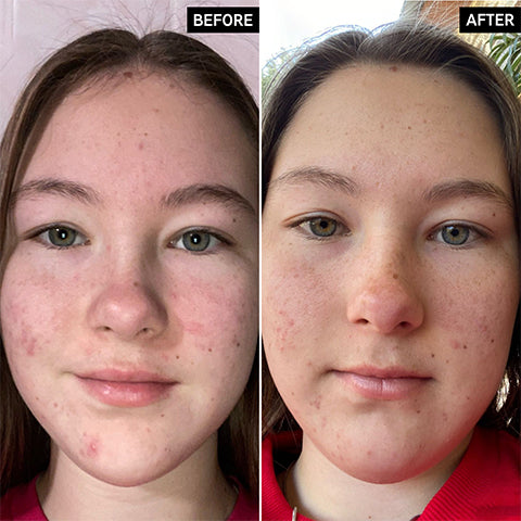 Blemishes & Scarring Results With INKEY