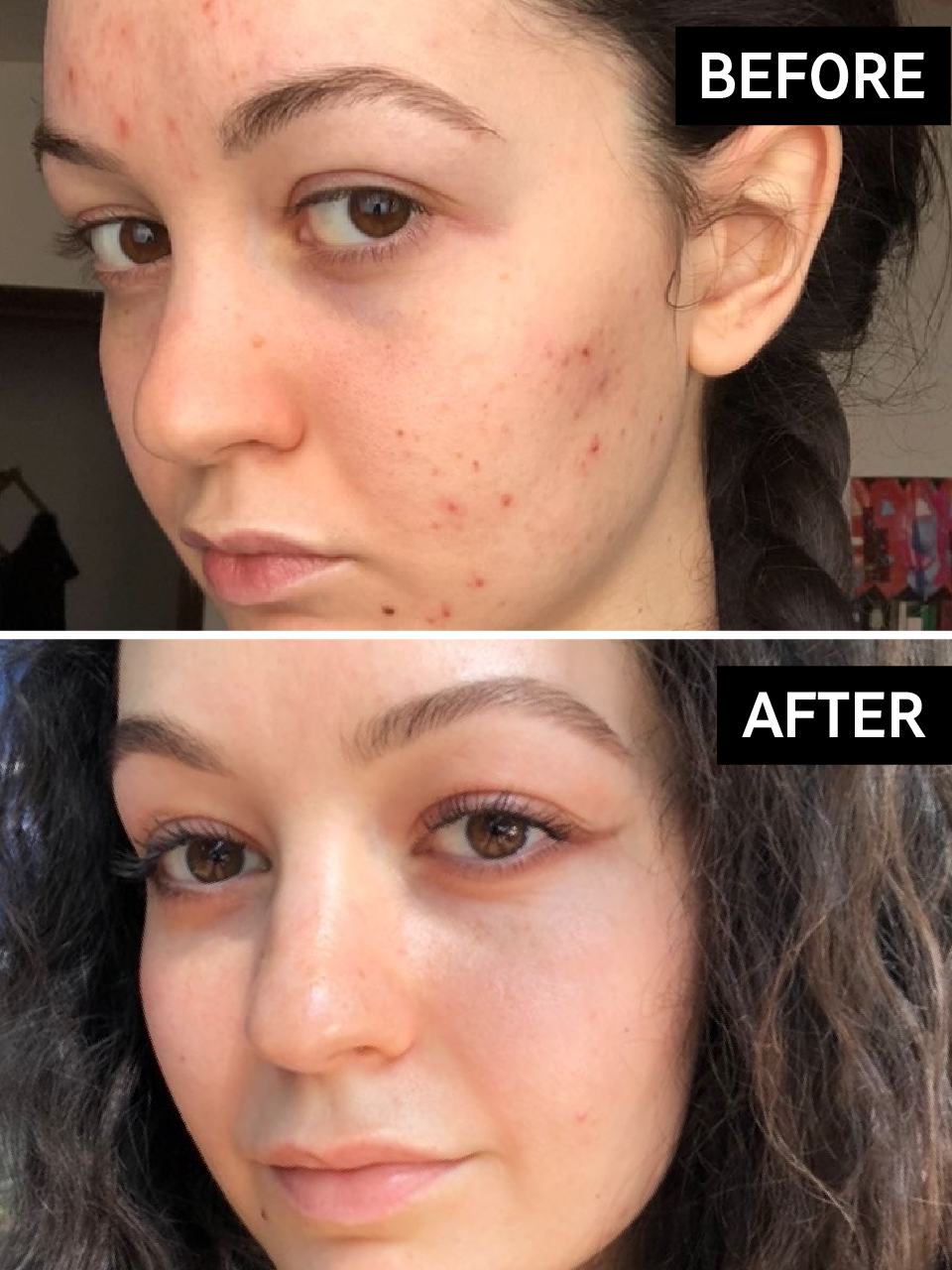 Hyperpigmentation Results Before & After With The INKEY List