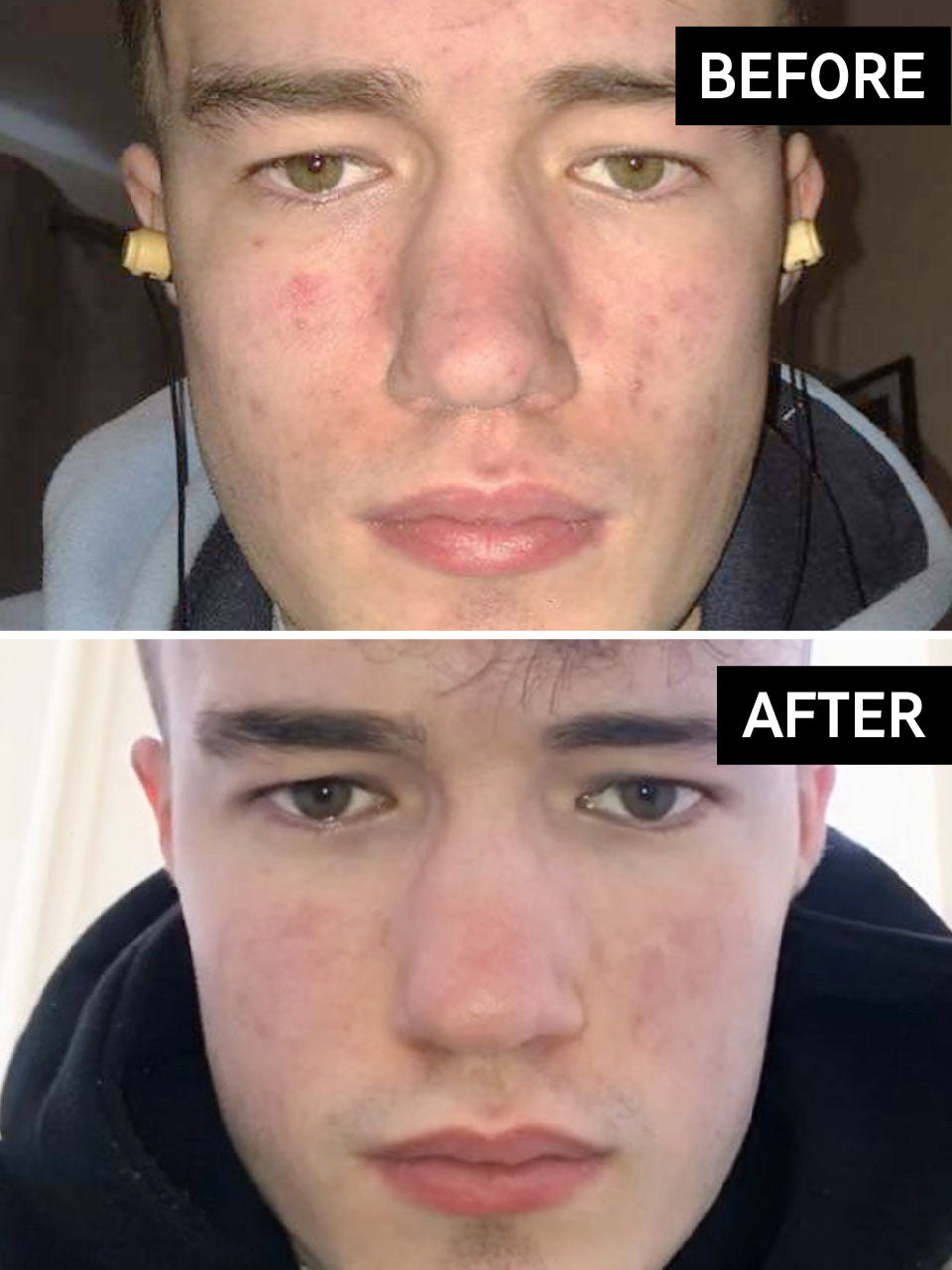 salicylic acid before and after