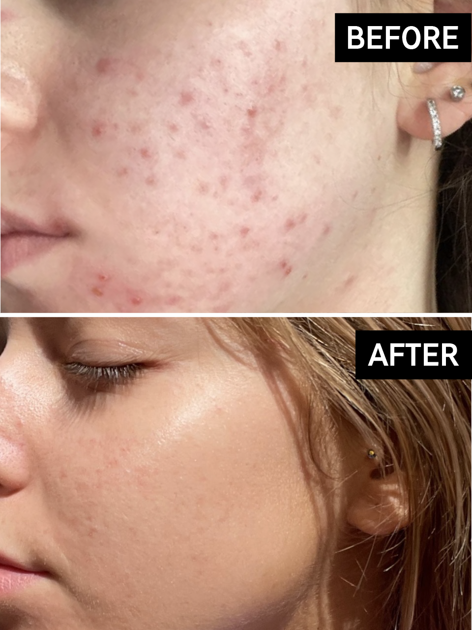 salicylic acid before and after