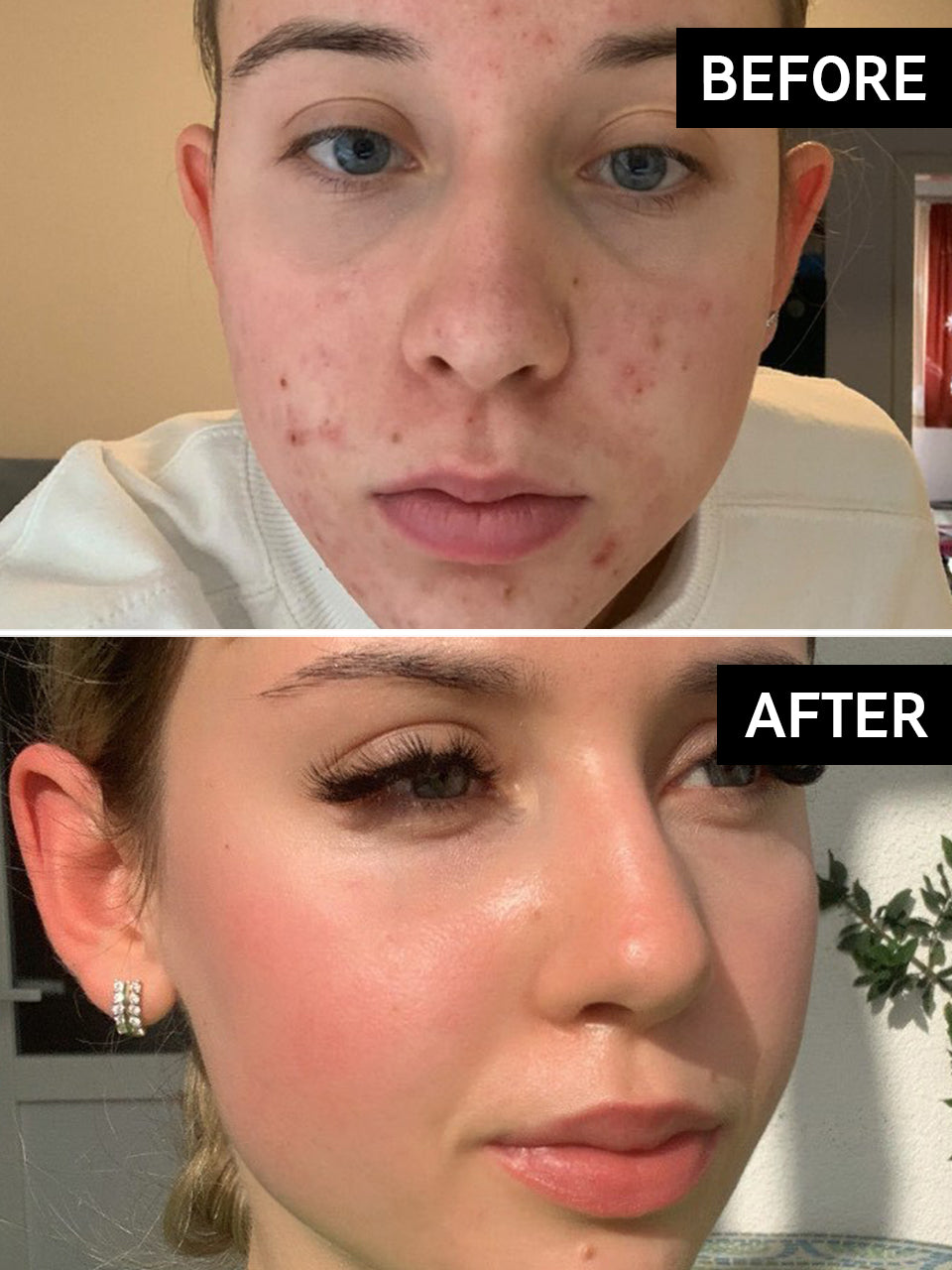 Hyperpigmentation Results Before & After With The INKEY List