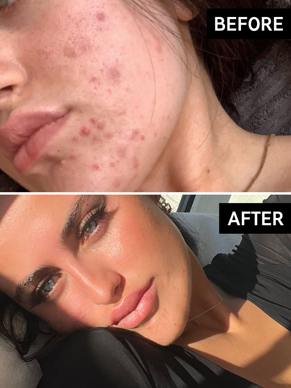 Hyperpigmentation Results Before & After With The INKEY List