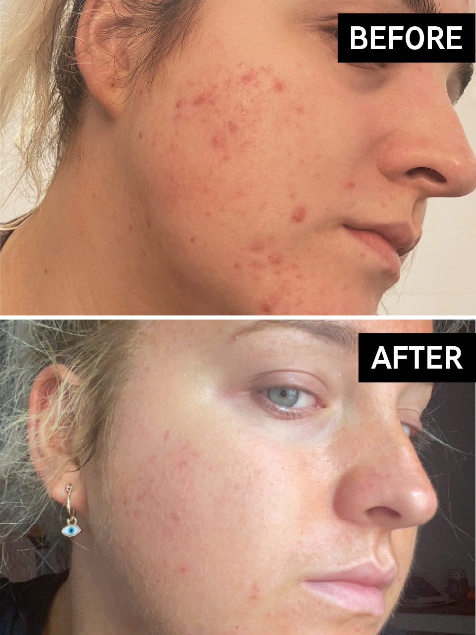 Hyperpigmentation Results Before & After With The INKEY List