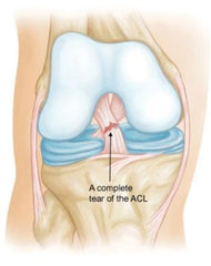 ACL Injury Rupture Anterior Cruciate Ligament 