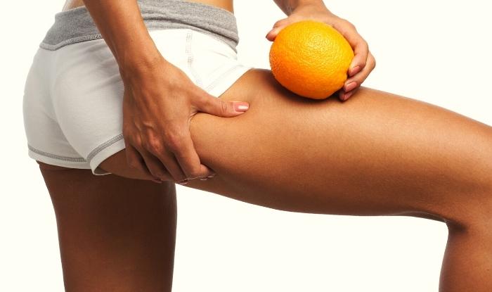 Woman showing cellulite.