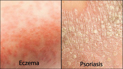 Eczema vs Psoriasis